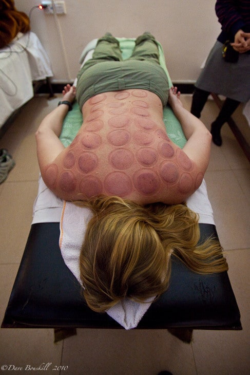 hot cupping china back