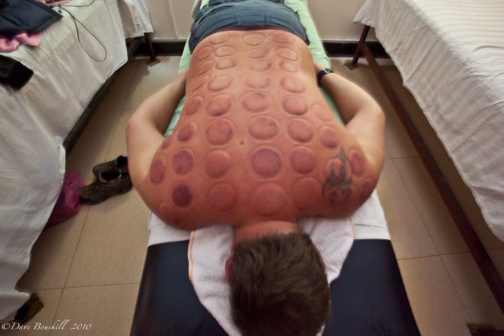 hot-cupping-china-dave.jpg