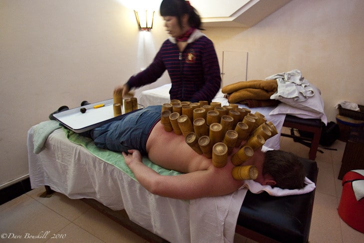 hot cupping procedure