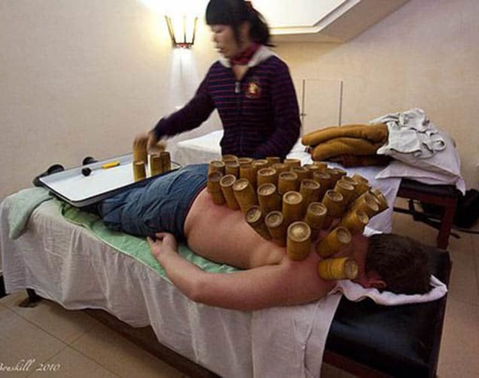 Hot Cupping in China Therapy or Just Pain?